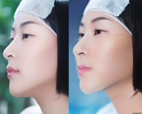 好，我现在需要帮用户写一篇关于鼻小柱延长的文章。用户是一位上海的鼻整形医生，所以文章需要专业且详细。首先，我得理解用户的需求，他们可能需要一篇结构清晰、内容详实的文章，用于介绍鼻小柱延长手术